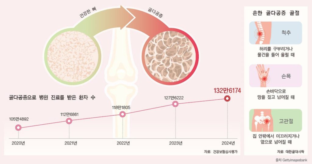 골다공증, 조용히 찾아오는 건강 위험의 숨겨진 신호들